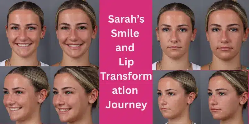 Meet Sarah, a 25-year-old who trusted us to enhance her smile and lip aesthetics. With Botox for a gummy smile, a lip flip, and lip fillers, we’ve helped her achieve a balanced, natural, and fuller look. One month later, the results speak for themselves!